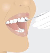 Fluoridierung der Zähne